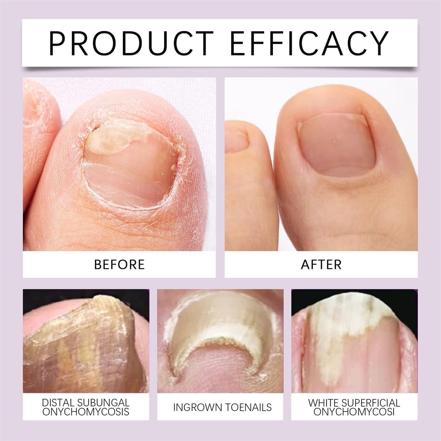 Fungi Free Bee Venom Nail Treatment Solution Serum Buy 1 Get 1 Free