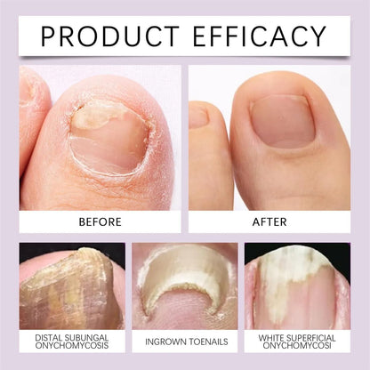 ShinyNailz™ Bee Venom Nail Fungus Solution – Fast Healing Formula(Pack of 2)
